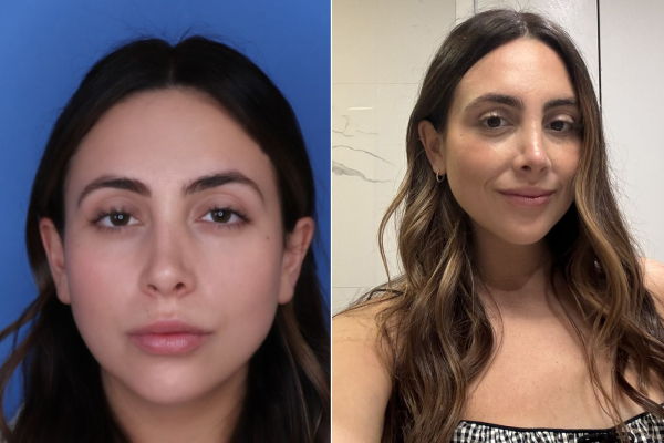 before and after a revision rhinoplasty